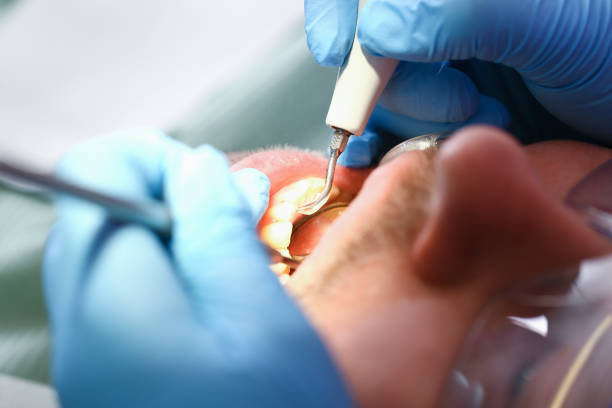 Best Knocked-Out Tooth (Avulsed Tooth) Treatment in Hyde Rk, PA